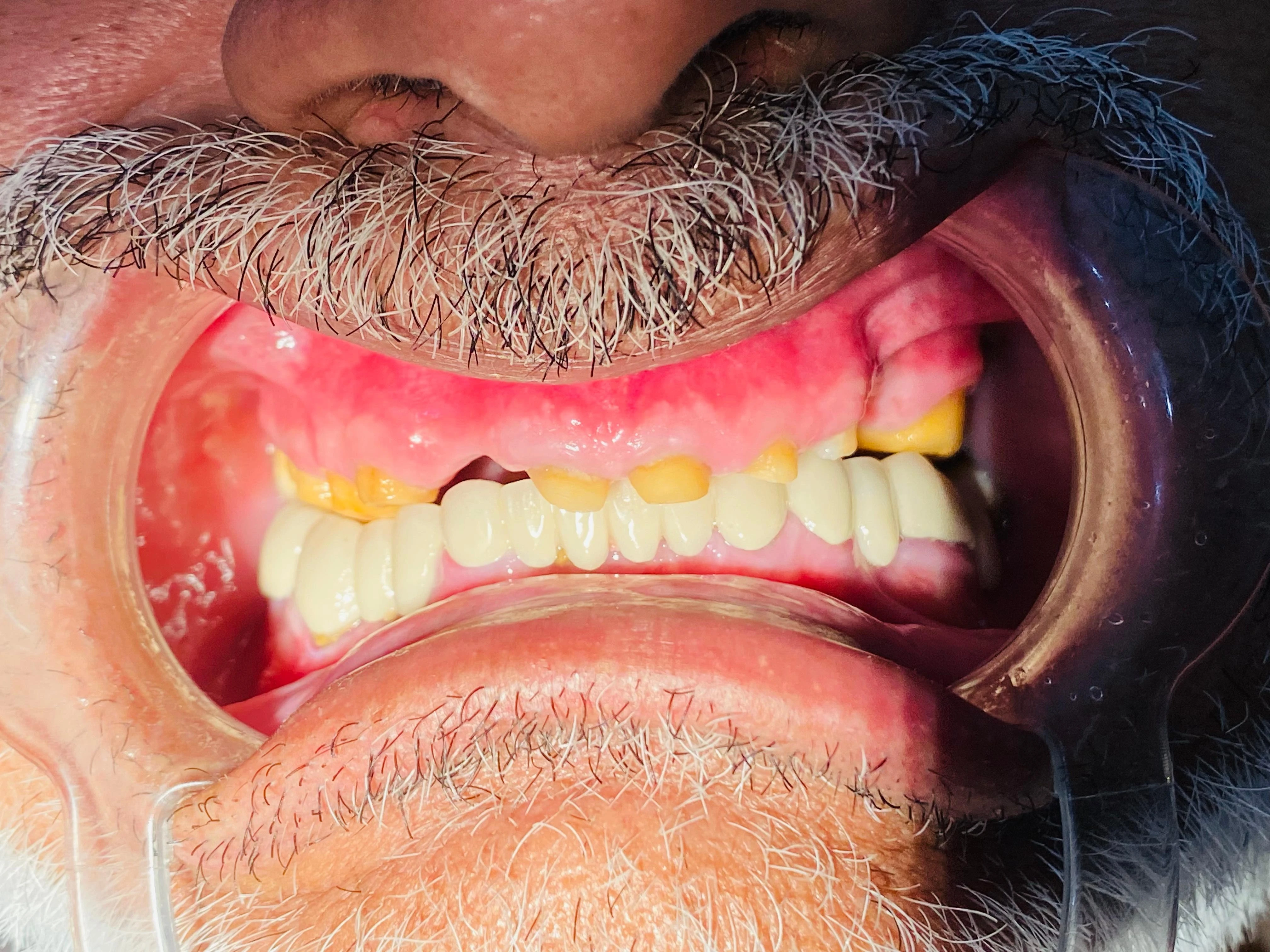 PFM CROWNS  — before treatment