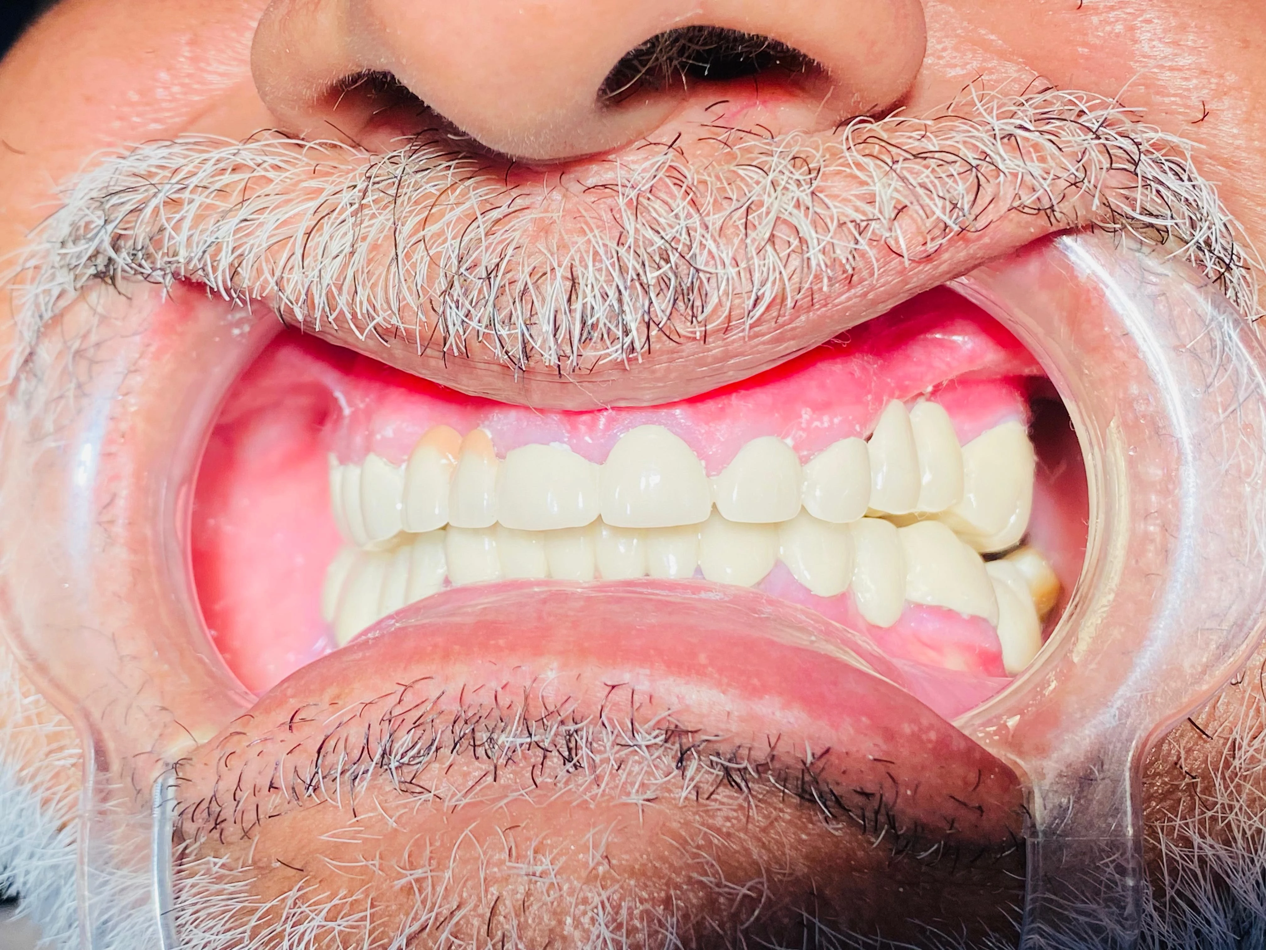 PFM CROWNS  — after treatment