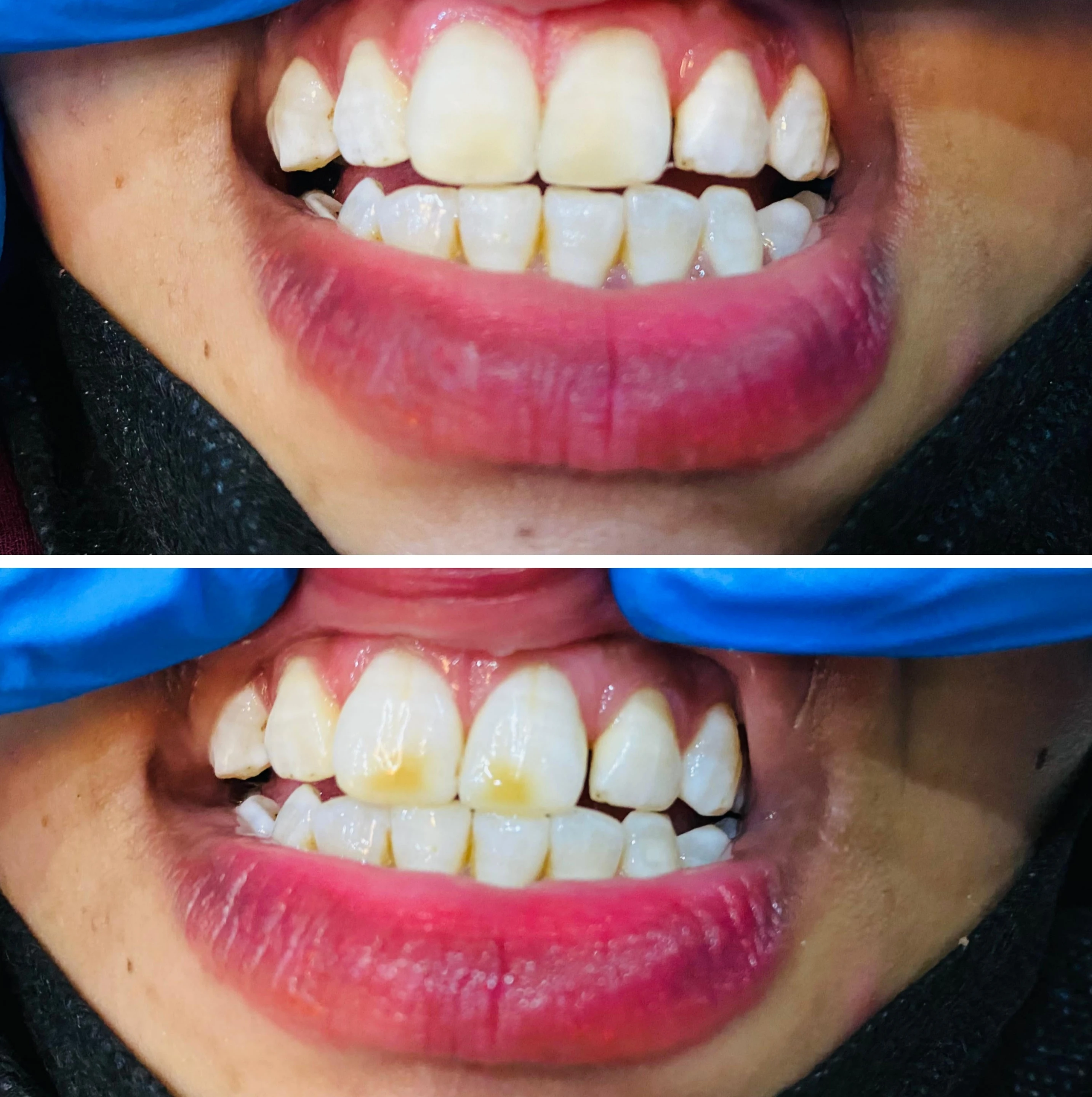 Direct composite veneer — before treatment