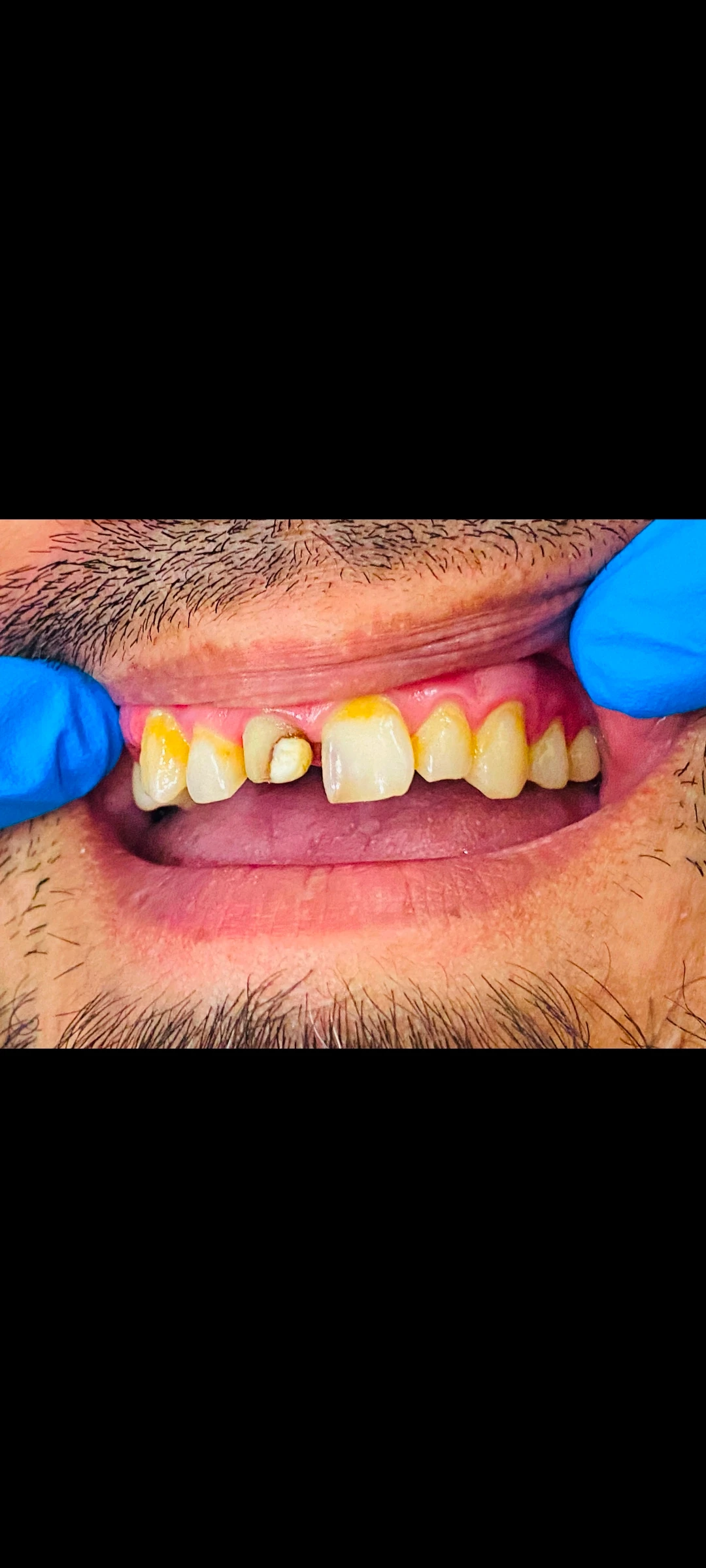 Pfm crown  — before treatment