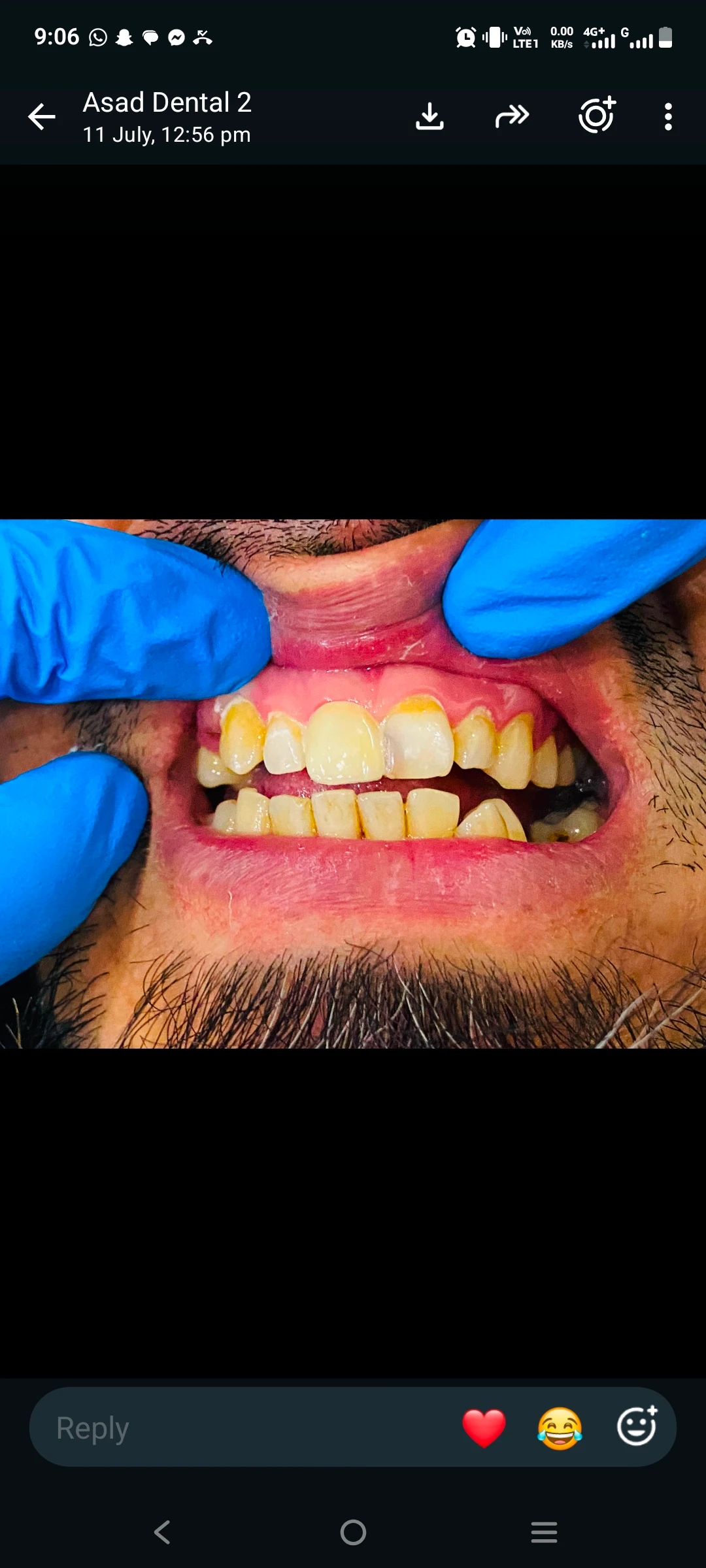 Pfm crown  — after treatment